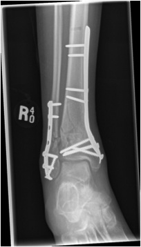 Distal Tibial Fracture ORIF